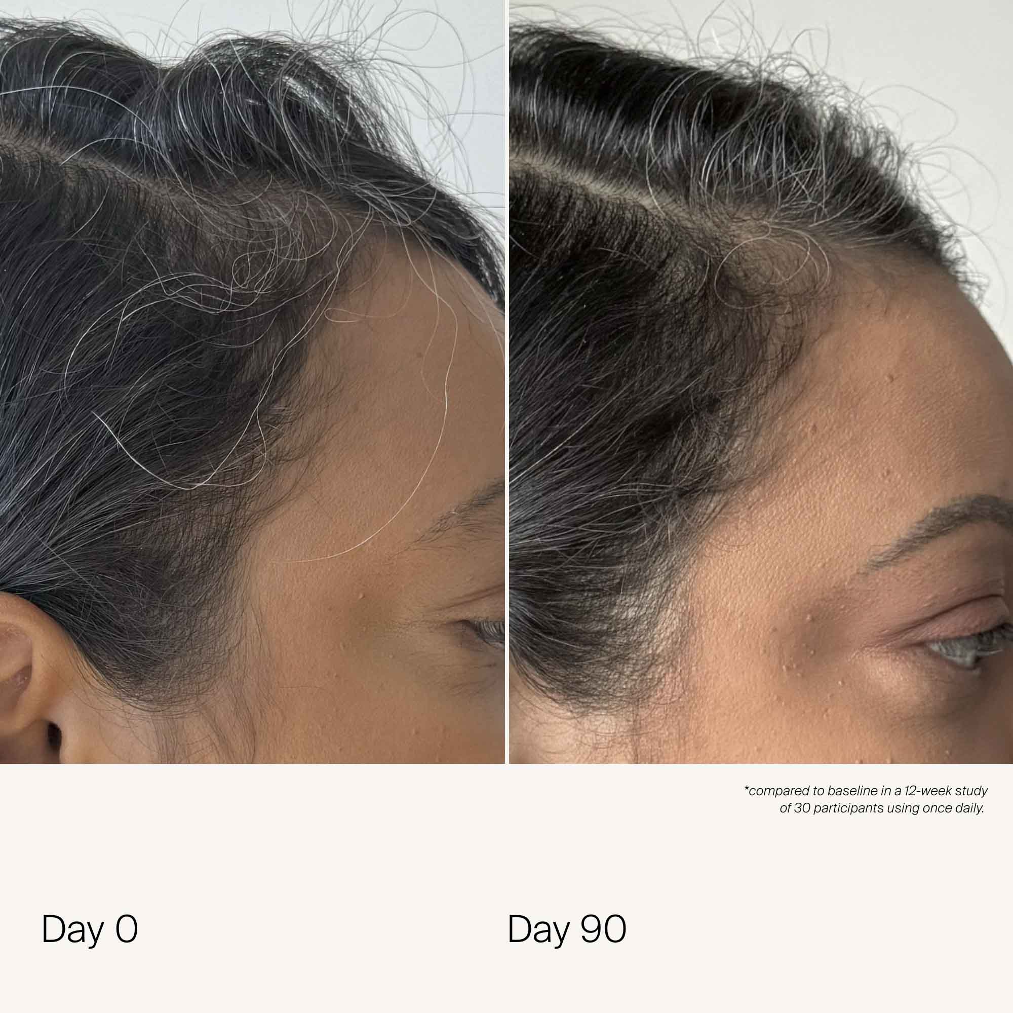 Side-by-side close-ups of a person’s hairline and temple labeled Day 0 and Day 90 show less grey hair and fuller coverage after consistent use of Scalp Care Density Serum.