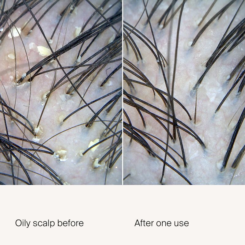 Close-up comparison of a scalp before and after using Scalp Care Exfoliator: the left shows oily buildup, while the right appears cleaner with reduced visible buildup and dry scalp flaking after one use.