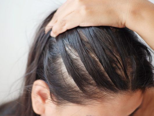 10 Common Causes of Oily Hair