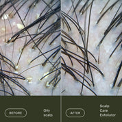 Side-by-side close-up images of a scalp: the left shows oily skin with yellow flakes, while the right reveals clearer skin after using Scalp Care Exfoliator to exfoliate and reduce dry scalp flaking.