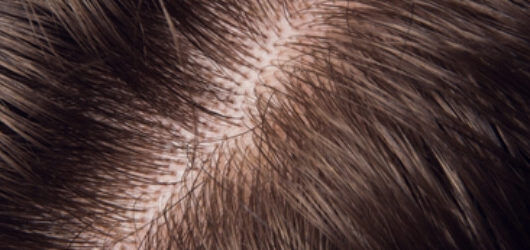 A close-up view of the healthy scalp of a person with straight, fine brown hair.